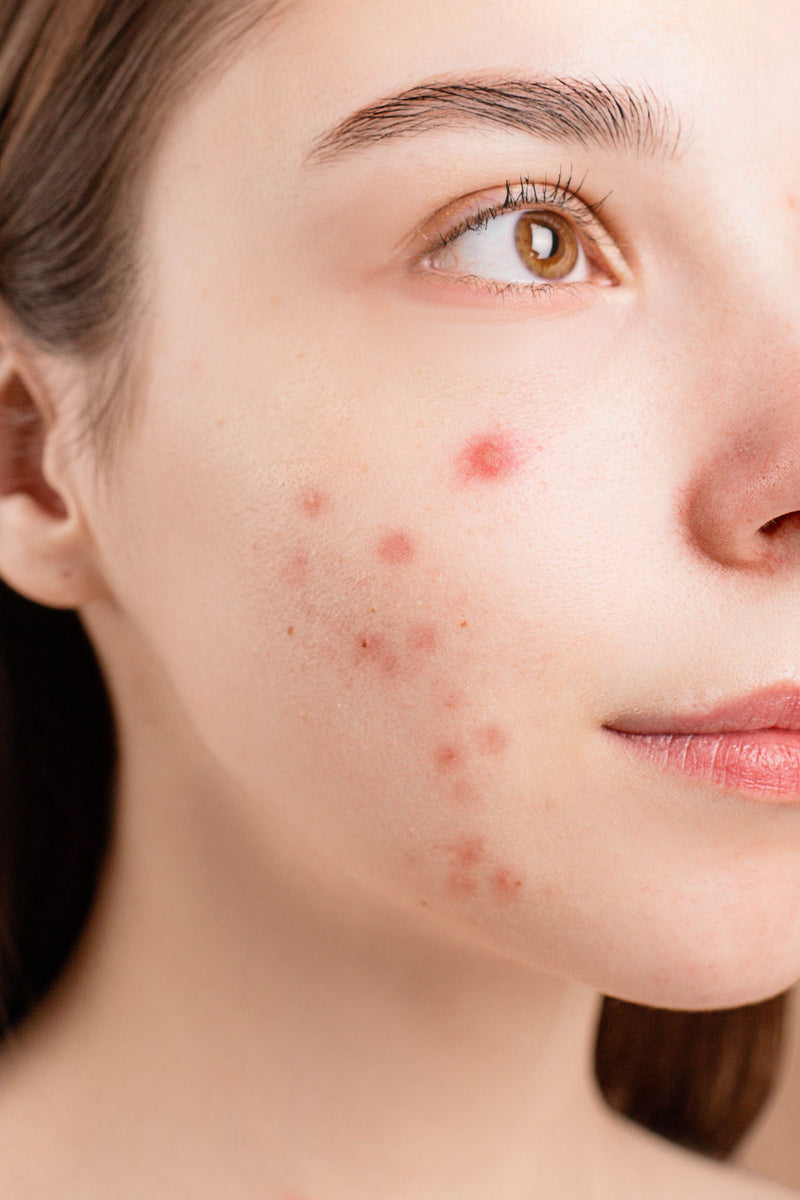 Acne Prone