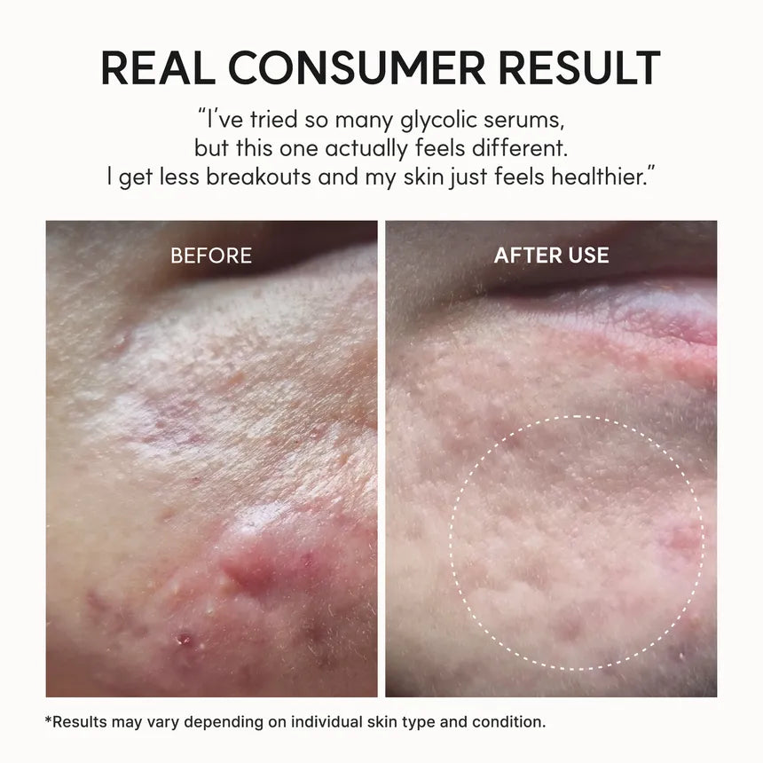 Arencia - Eraser Shot Glycolic Acid Booster